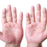 手湿疹と汗疱の違い